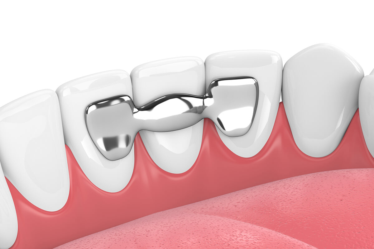 can-a-dental-bridge-be-removed-and-recemented-chagrin-falls