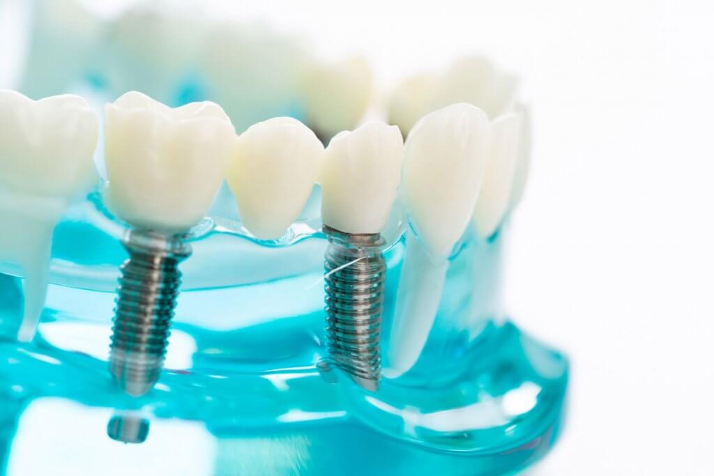 How Much Do Dental Implants Cost in Ohio? | Chagrin Falls